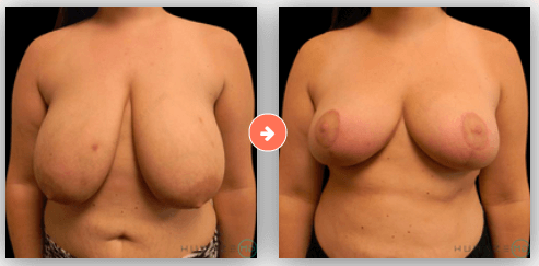 Breast Reduction in Nashville