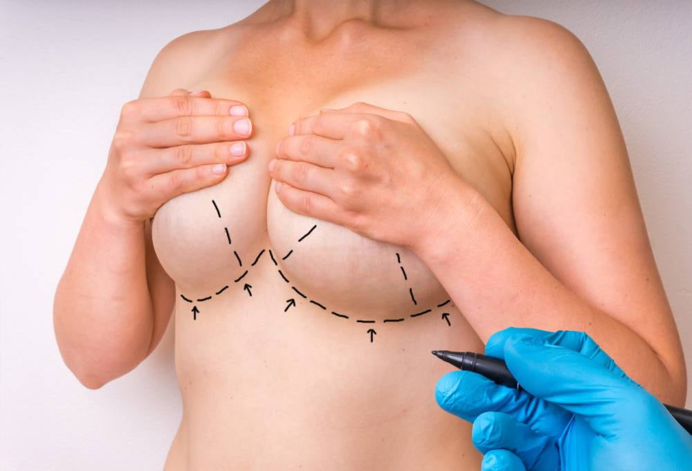Five Myths About Breast Reduction