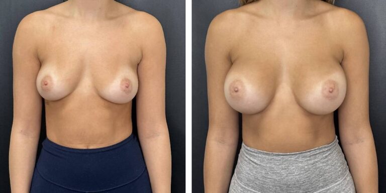 before and after breast augmentation female patient front view case 1996