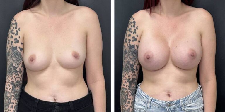 before and after breast augmentation female patient front view case 2006