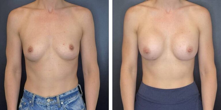 before and after breast augmentation female patient front view case 2012