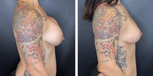 before and after breast lift right side view case 1311