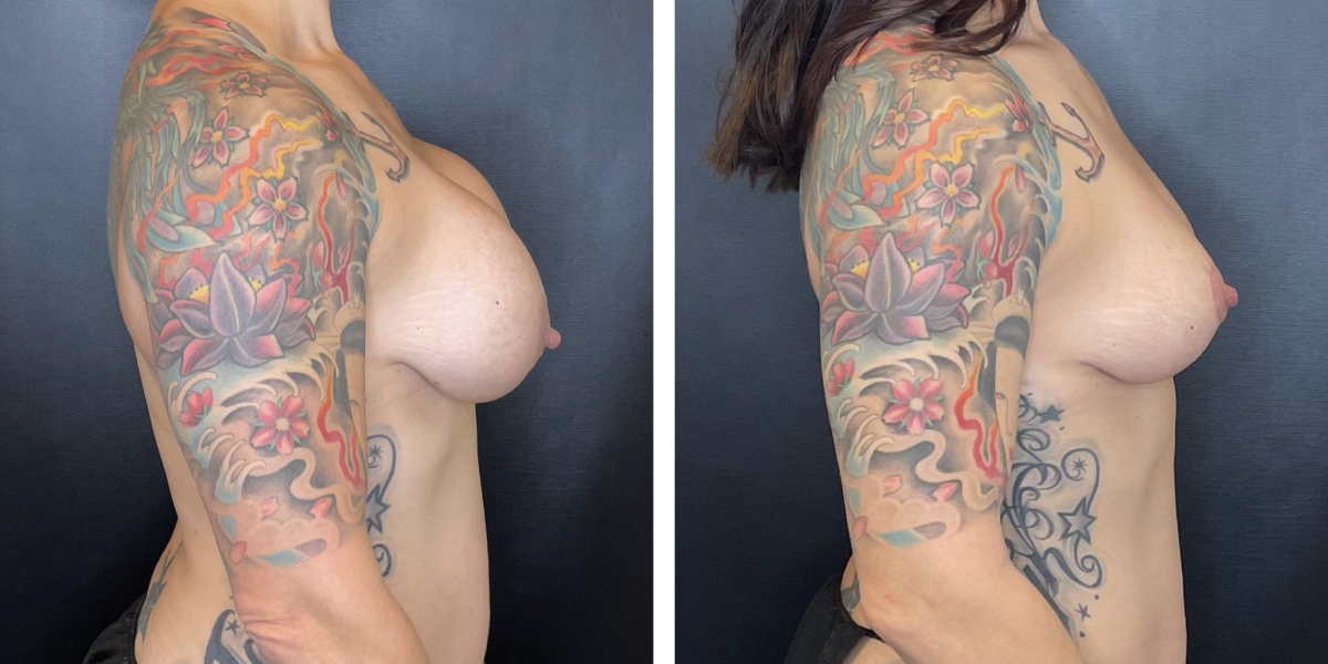 before and after breast lift right side view case 1311