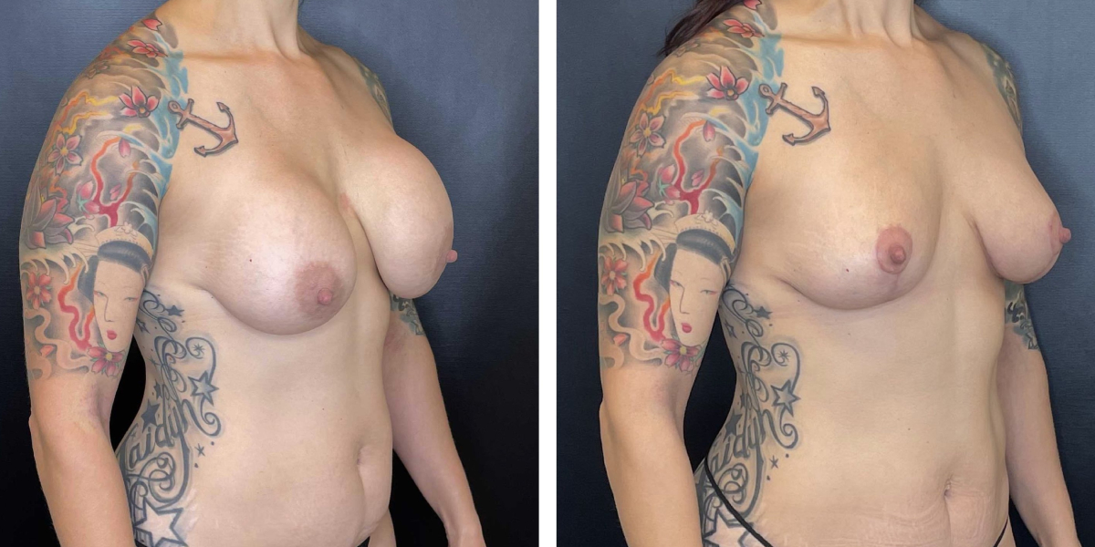before and after breast lift right angled view case 1311