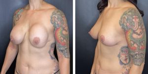 before and after breast lift left angled view case 1311