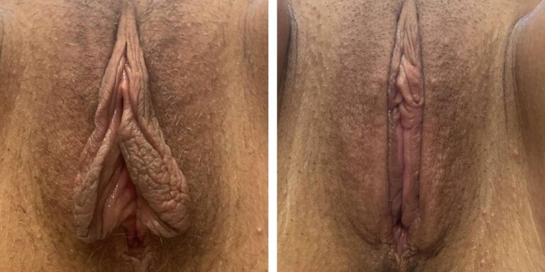 before and after labiaplasty front view case 1859
