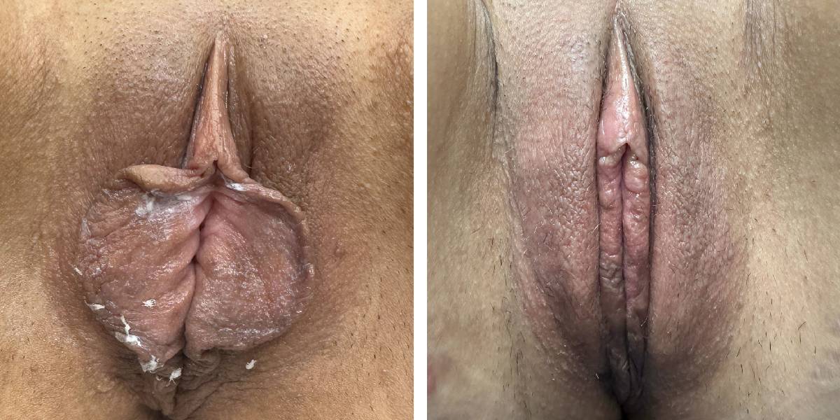before and after labiaplasty front view case 1877